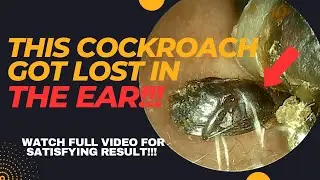 How Did This COCKROACH Got Lost In The EAR⁉️ The Answer Is Still A Mystery