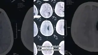 BRAIN 🧠 SURGERY #doctor #viral #youtubeshorts