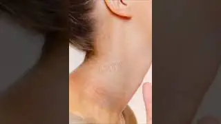 गर्दन के कालेपन कैसे दूर करे | Dark Neck Home Remedy | How to get rid of dark Neck fast