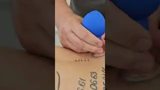 Schröpfmassage zur Narbenpflege
