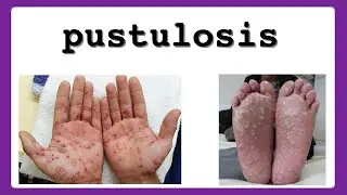 pustulosis
