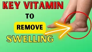 The key VITAMIN for REMOVING SWELLING IN HANDS, LEGS, FEET