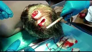 Удаление огромных атером головы