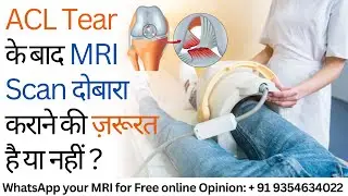ACL Tear के बाद MRI दोबारा कराने की ज़रूरत है या नहीं ? Repeat MRI Scan after ACL Injury