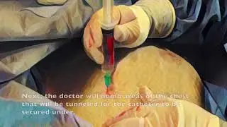 What is tunneled central venous catheter placement?