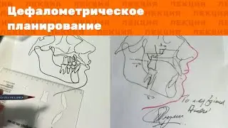 Лекция: Цефалометрическое планирование