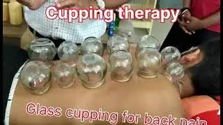 Cupping Therapy - Glass Cupping ( Best way to treat your Back Pain)