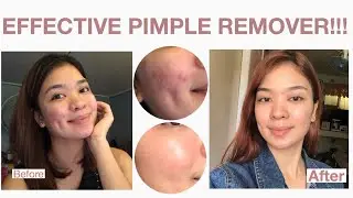 RDL BABY FACE | EFFECTIVE TALAGA!! (1 Month Review)
