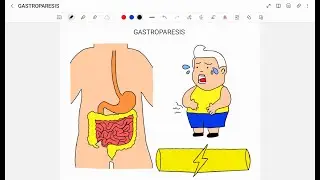 GASTROPARESIS