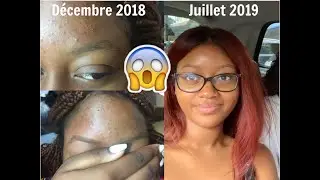 SKINCARE : 10 conseils pour vous debarrasser de votre acné ! PART 1