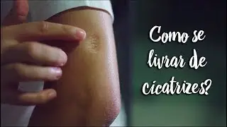 Fica a Dica - Como se livrar de cicatrizes? - by Farmácias Pague Menos