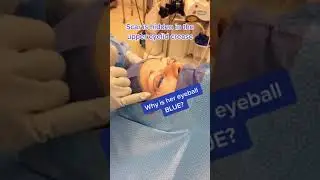 Upper eyelid lift in the OR 