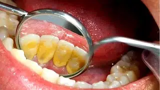 DENTISTA REMOVENDO TÁRTARO #21 [Procedimento completo]