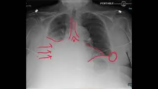 Pleural effusion podcast