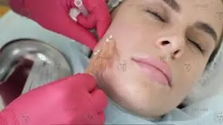 Коррекция овала лица нитями Lift Line Nata
