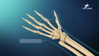 Fractura de radio distal o muñeca