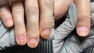 NAIL BURN🤍relapse