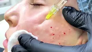 Плазмалифтинг. Prp и биоревттализация