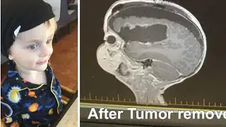 Anaplastic Ependymoma  Story | Fionn Story