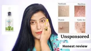 Mamaearth Tea tree face serum honest review | Non Sponsored  | best for Acne skin ?