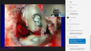 2017 07 07  Герметизация каналов   латеральная конденсация vs вертикальная конденсация гуттаперчи
