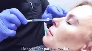 PDO Thread Nose Lift by Dr. Pierone