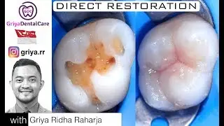 Direct Restoration Composite Class 1 Posterior / Penambalan gigi dengan Komposit Kelas 1