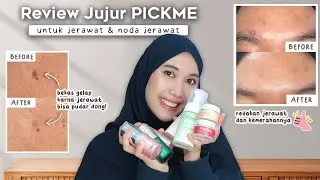 Skincare Jerawat & Bekas Jerawat dari Pickme - HONEST REVIEW