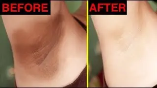 How To Get Rid Of Dark Underarms | Lighten Dark Underarms | Underarms Whitening At Home
