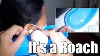 Cockroach Stuck for Days Inside Woman's Ear Removed