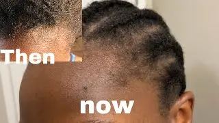 How I manage DRY scalp and edges|| DRY scalp care while in cornrows