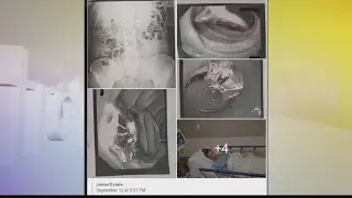 WOMAN SWALLOWS ENGAGEMENT RING IN SLEEP