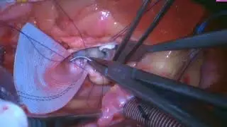 Mechanical AVR With Y-Incision Aortic Annular Enlargement