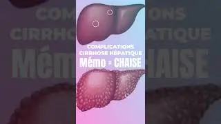 Mémo : Complications de la Cirrhose Hépatique