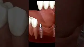Animated Partial Fixed Denture (AKA Fixed Bridge)
