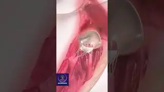 Mitral Valve Anatomy 3D Animation 