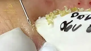 Extreme Pimple Popping How Far Will You Go 2023
