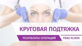 Круговая подтяжка лица, 3 недели после операции. Хирург - доктор Абрамян