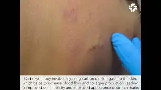 SAY GOODBYE TO STRETCH MARKS WITH CARBOXYTHERAPY: A SAFE & AFFORDABLE SOLUTION