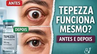 Nova medicação para Orbitopatia de Graves - tepezza