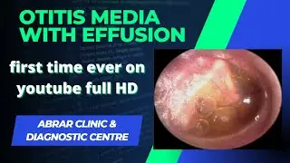Otitis media with effusion | glue ear | secretory otitis media