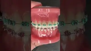 Braces Emergency: At-Home Fixes if your Colored Ties Came Off