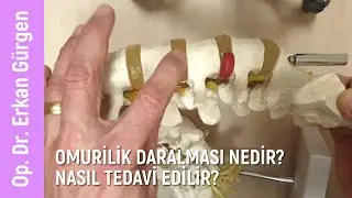 Omurilik daralması nedir? Nasıl Tedavi Edilir?