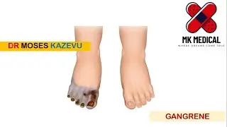 Gangrene