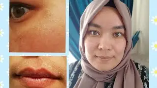 YUZLMDAGI DOĞLAR🤔 DOĞ VA CHANDIQ YO'QOTUVCHI KREM, EXPIGMENT VA MADECASSOL KREMI HAQIDA MALUMOTLAR