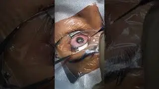 Femto Lasik Contoura!! 