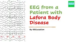 EEG in Lafora Body Disease