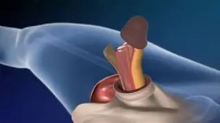 Sex Changed, Male Convert To Female Animation - Medical Information