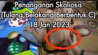 penanganan Terapi pada anak sakit skoliosis (Tulang Membentuk Huruf C)