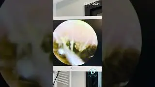 Earwax removal